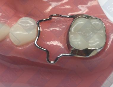 Spacer 1 “Adjustable Band and Loop Spacer”